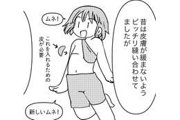 胸の全摘手術。昔と今の「縫い方」の違いは、胸の「再建」のため【乳癌日記 #53】