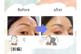 「おでこにシワがなくなるだけでこんなに違うの!?」43歳、5分で若見えするコスパ抜群な美容医療にハマった理由
