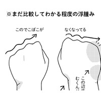 術後9ヵ月に発症した「リンパ浮腫」。有効なケア法を試してみたら、むくみ具合が…【乳癌日記 #50】