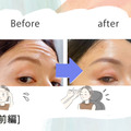 「おでこにシワがなくなるだけでこんなに違うの!?」43歳、5分で若見えするコスパ抜群な美容医療にハマった理由 画像