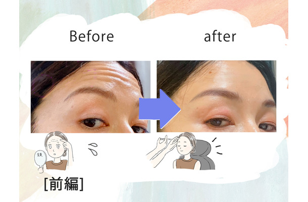 「おでこにシワがなくなるだけでこんなに違うの!?」43歳、5分で若見えするコスパ抜群な美容医療にハマった理由