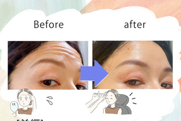 「おでこにシワがなくなるだけでこんなに違うの!?」43歳、5分で若見えするコスパ抜群な美容医療にハマった理由 画像