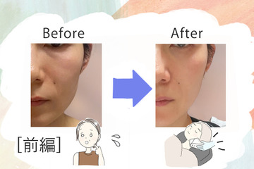 美容課金にハマった44歳が人生初のハイフを体験。「実は一番悩んでいた」たるみはどう変わるのか？気になる痛みは？ 画像